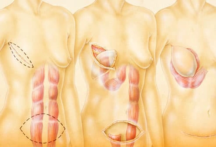 Breast Reconstruction Breast Reconstruction