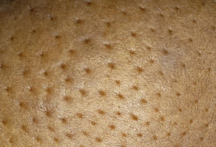 Signs of Inflammatory Breast Cancer Signs of Inflammatory Breast Cancer