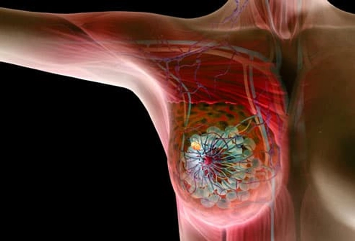 Breast Cancer Symptoms Breast Cancer Symptoms