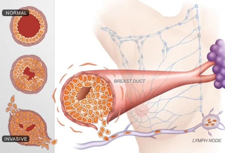 Breast Cancer Stages