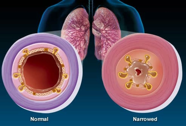 Bronchitis: Inside Your Lungs