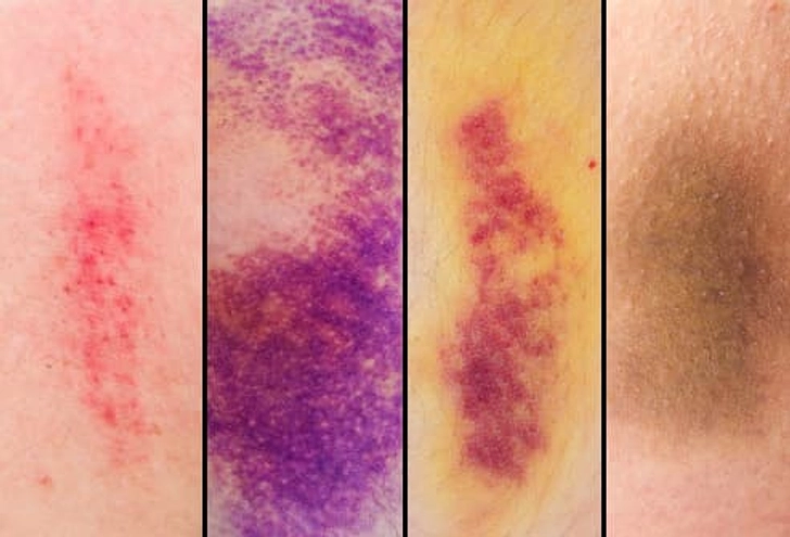 https://img.lb.wbmdstatic.com/vim/live/webmd/consumer_assets/site_images/articles/health_tools/bruise_guide_slideshow/493ss_thinkstock_rf_bruise_colors.jpg?output-quality=100&resize=728px%3A%2A&utm_source=chatgpt.com