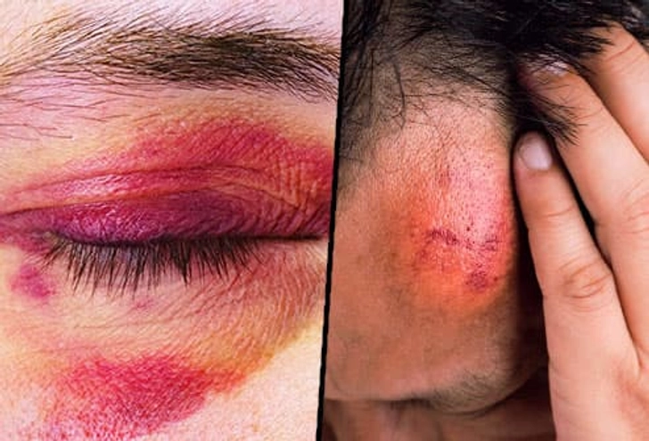 Types of Bruises