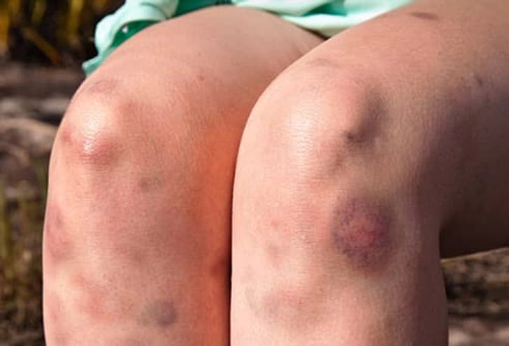 Why Do I Bruise Easily?