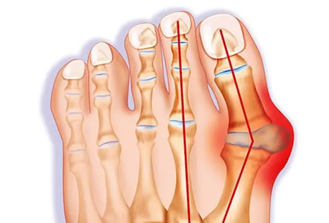 What Is a Bunion? What Is a Bunion?