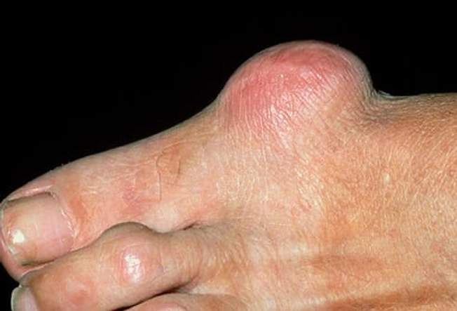 Complications: Bursitis Complications: Bursitis
