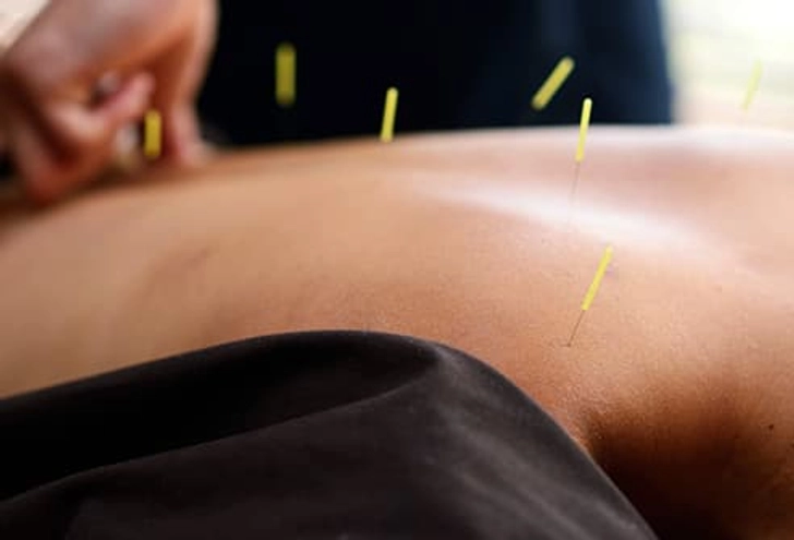Try Acupuncture Try Acupuncture