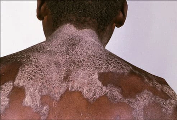 Pellagra