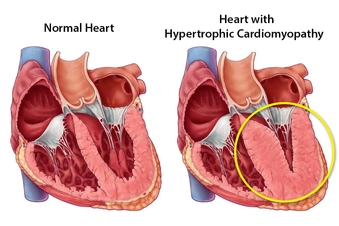 Hypertrophic Cardiomyopathy