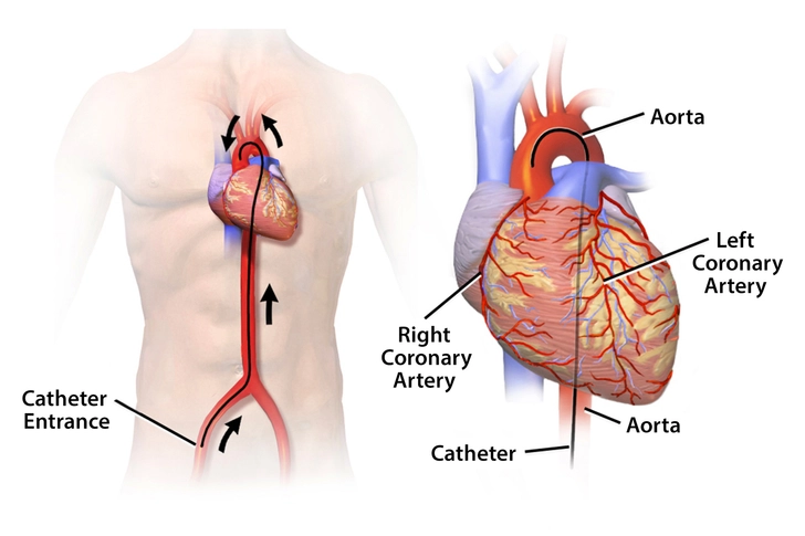 Cardiac Catheterization
