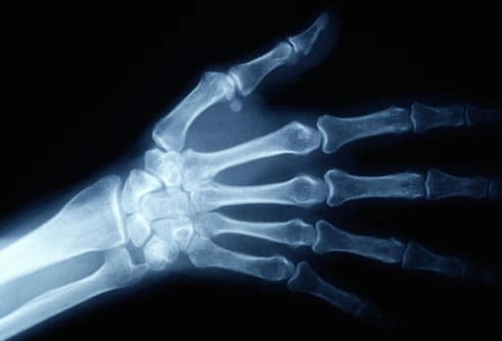 Carpal Tunnel or Something Else?