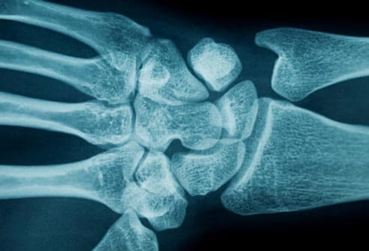 What Causes Carpal Tunnel Syndrome?