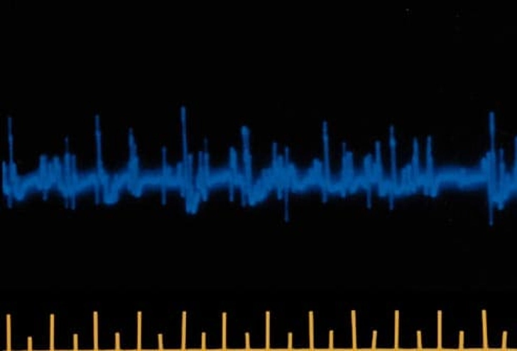 Electrodiagnostic Tests