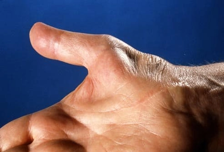 What Happens Without Treatment?