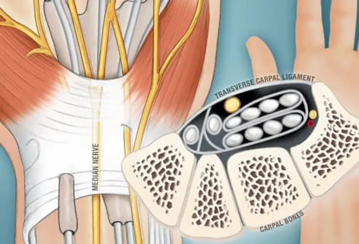 What Is Carpal Tunnel Syndrome? What Is Carpal Tunnel Syndrome?