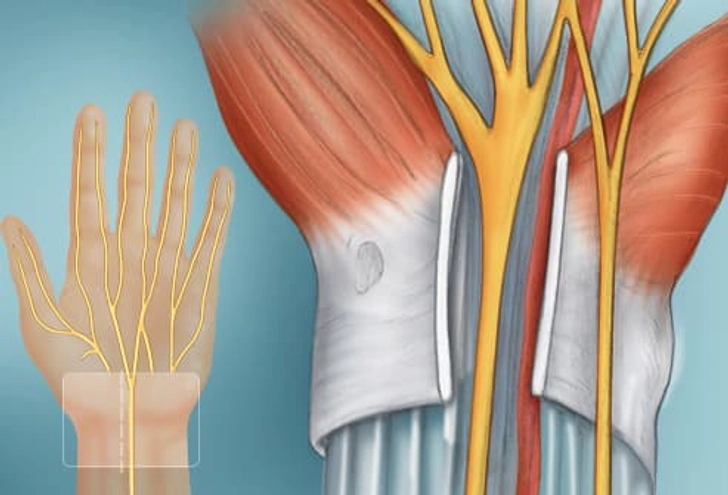 Surgery for Carpal Tunnel Syndrome