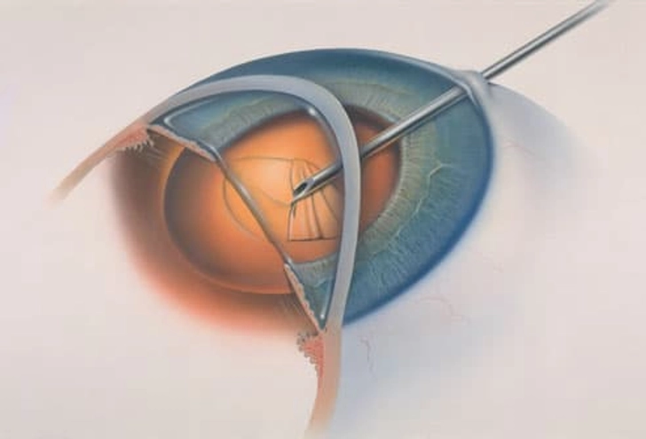 Types of Cataract Surgery