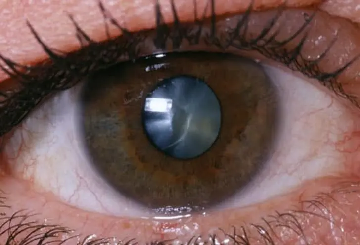 What Are Cataracts? What Are Cataracts?