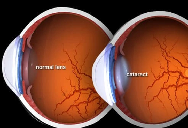 How Cataracts Affect Your Vision How Cataracts Affect Your Vision