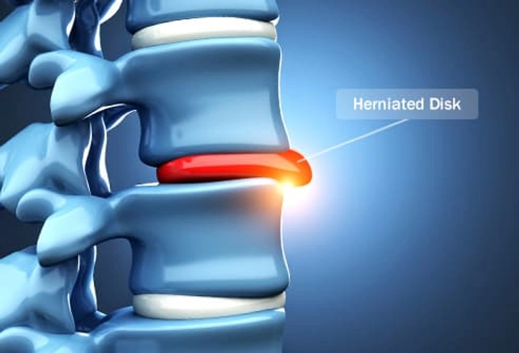 Herniated Disk