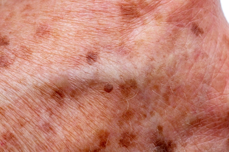 Age Spots Age Spots