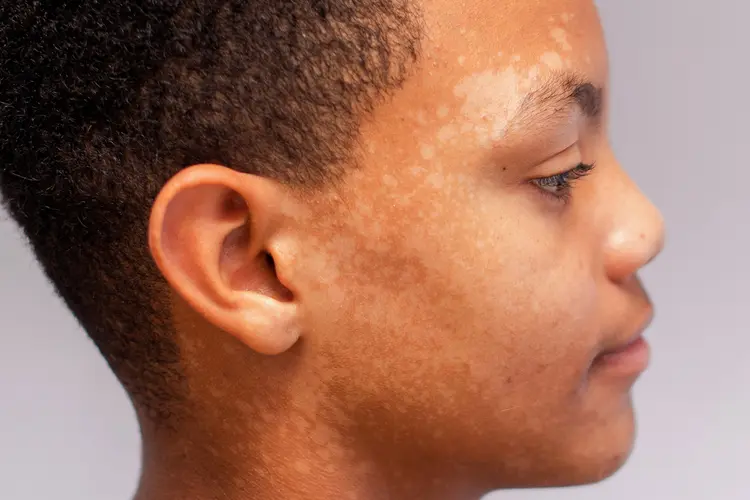 photo of tinea versicolor on face