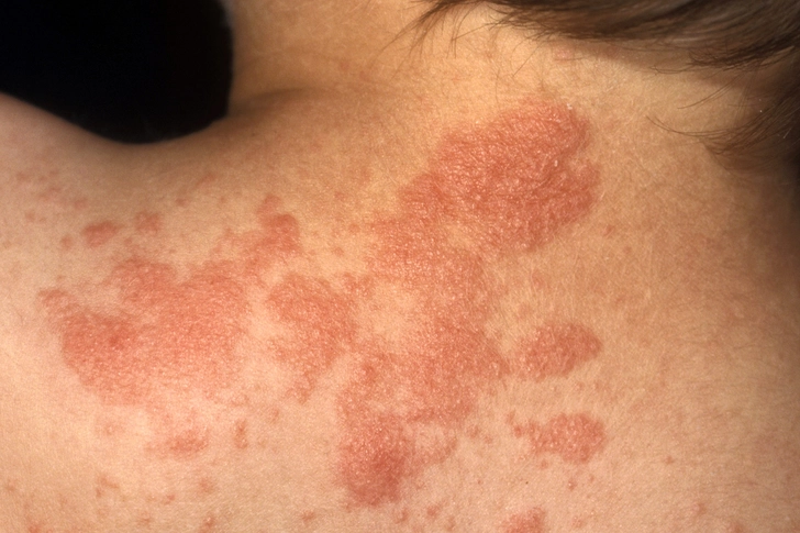 Contact Dermatitis Contact Dermatitis