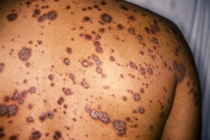 Psoriasis Psoriasis