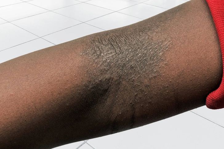 Eczema Eczema