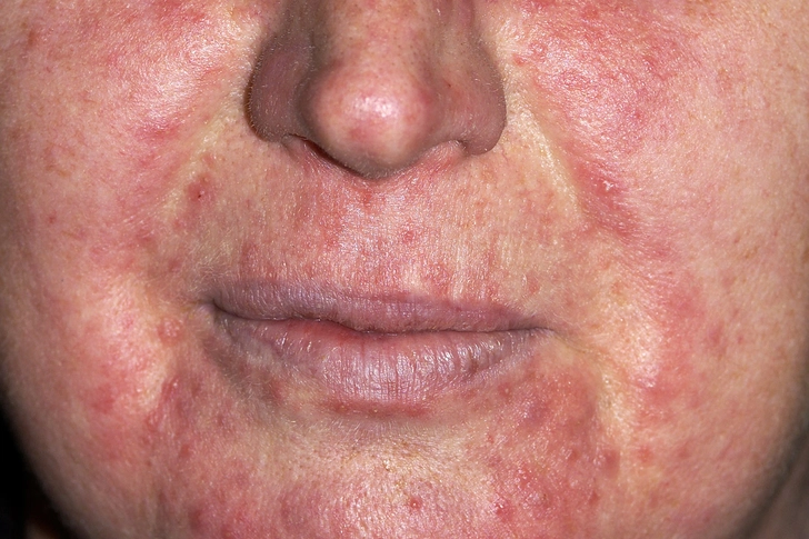 Rosacea Rosacea