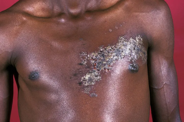 photo of shingles rash on chest