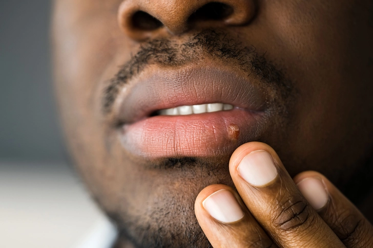 Herpes Simplex Herpes Simplex