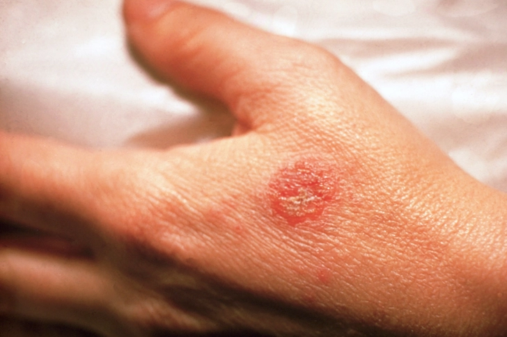 Nummular Eczema