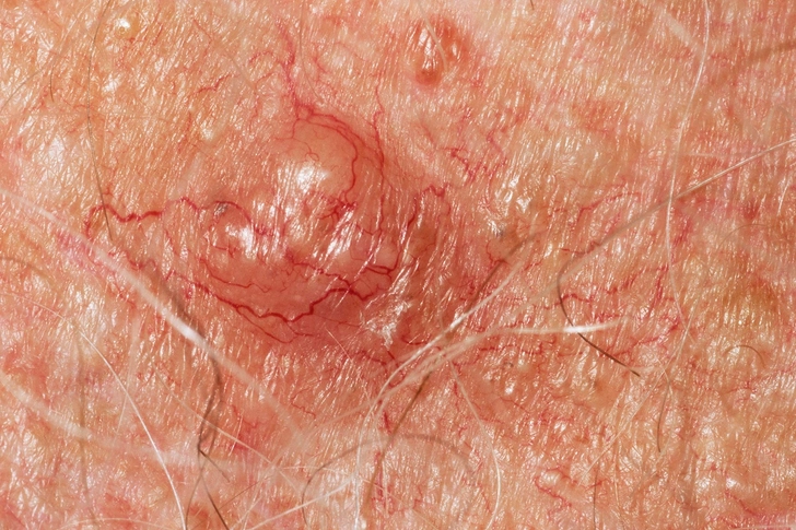 Skin Cancer