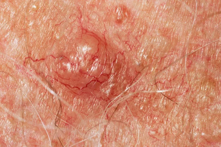 photo of skin cancer