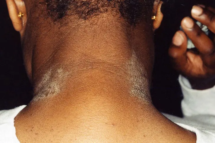 Allergic Eczema