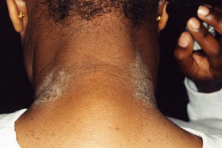 Allergic Eczema Allergic Eczema