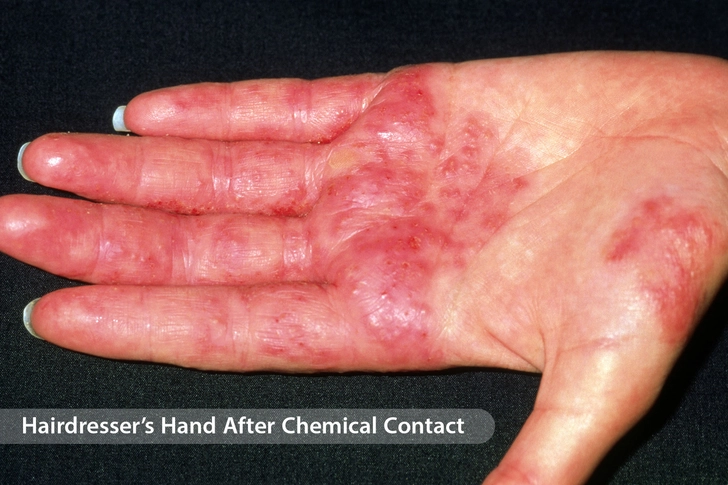 Contact Dermatitis