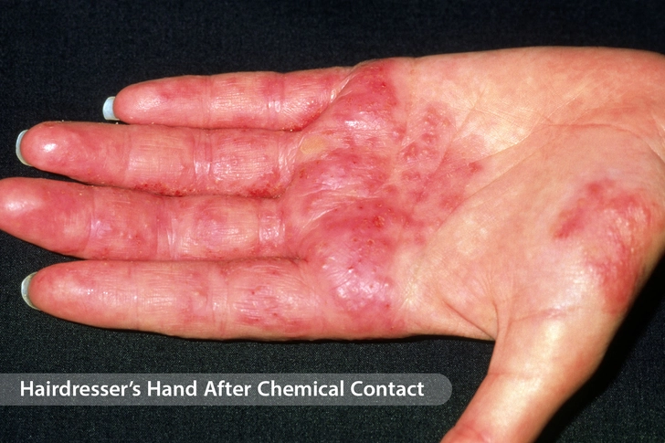 Contact Dermatitis Contact Dermatitis