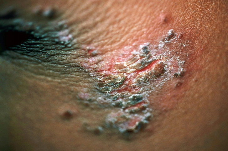 Impetigo Impetigo