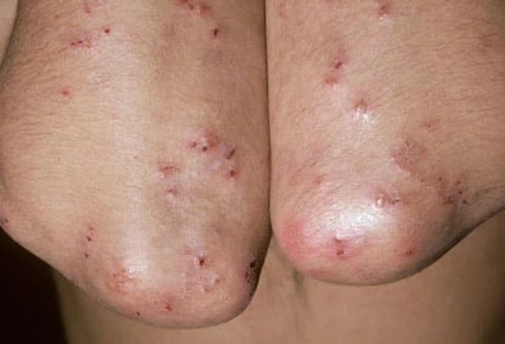 Celiac Symptoms: Skin Rash Celiac Symptoms: Skin Rash
