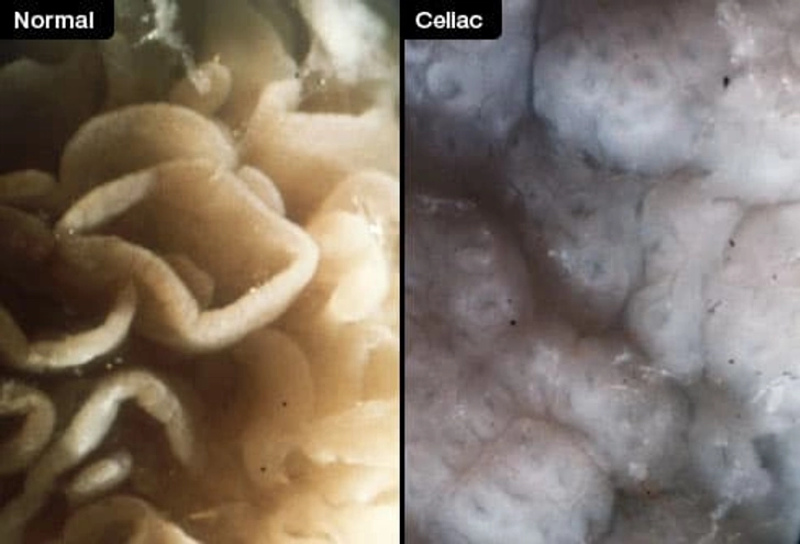 Celiac Damage in the Intestine