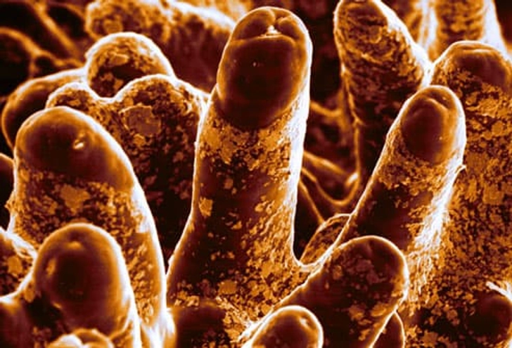 Diagnosis: Intestinal Biopsy