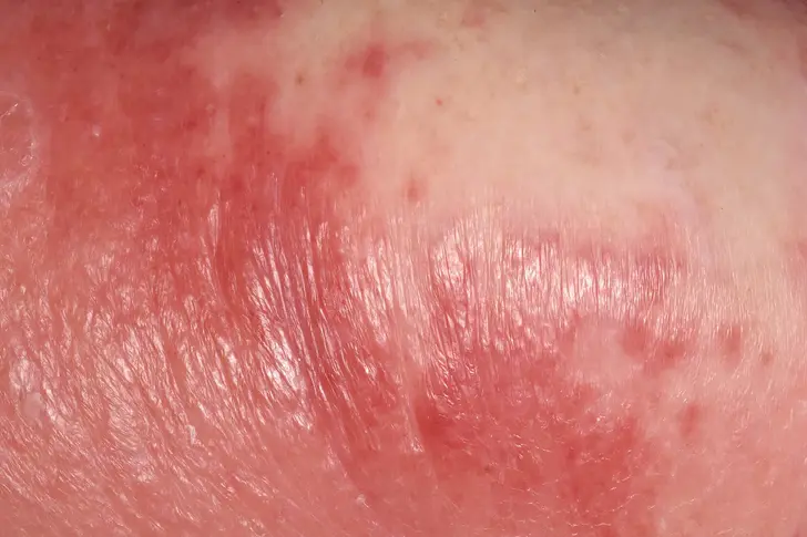 What Is Cellulitis?