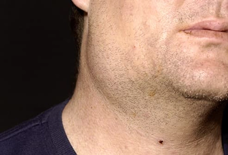 Mumps