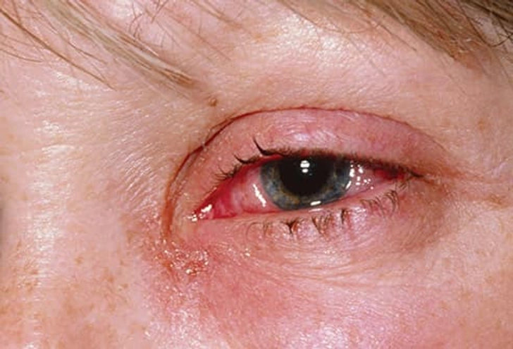 Pinkeye