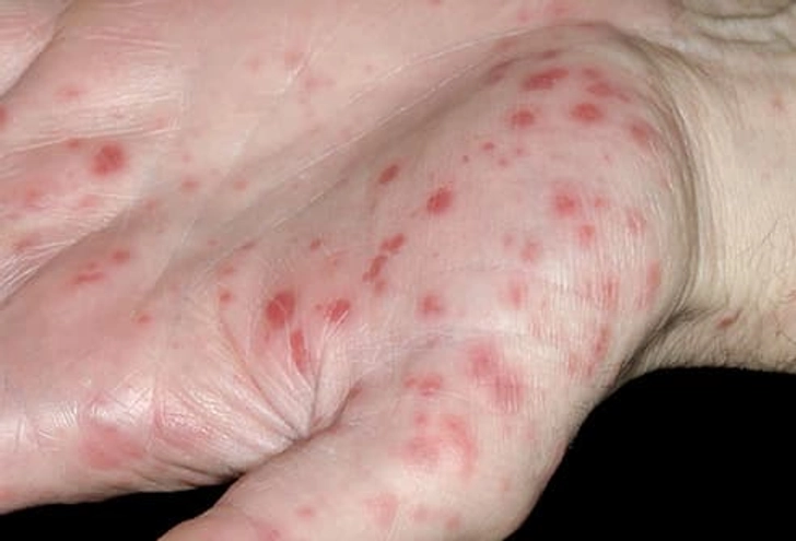 Hand, Foot, and Mouth Disease