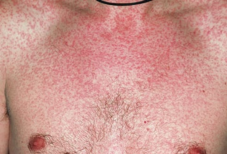 Measles