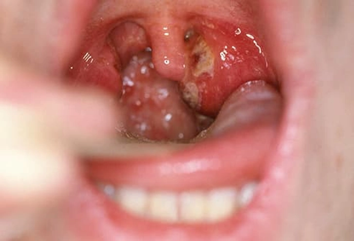 Strep Throat