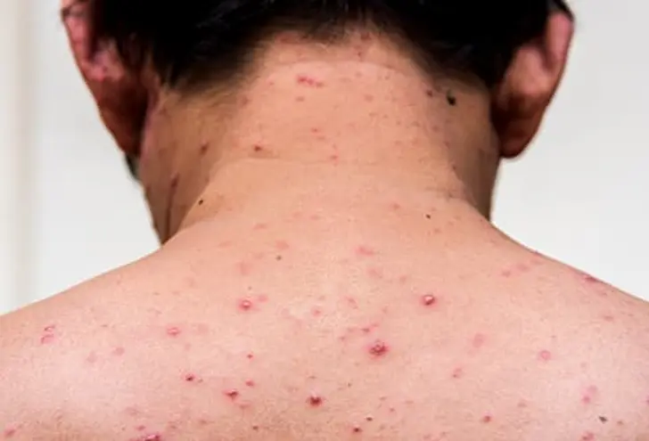 Chickenpox
